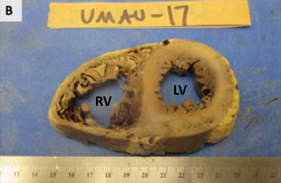 Fox S, Akmatbekov A, Harbert J, et al. Pulmonary and Cardiac Pathology in Covid-19: The First Autopsy Series from New Orleans. MedRxiv 2020.04.06.20050575; doi: https://doi.org/10.1101/2020.04.06.20050575